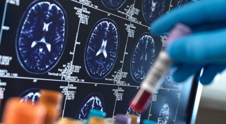 Nuevos pasos en la investigación del alzhéimer: el déficit de litio podría ser la clave en su aparición y tratamiento